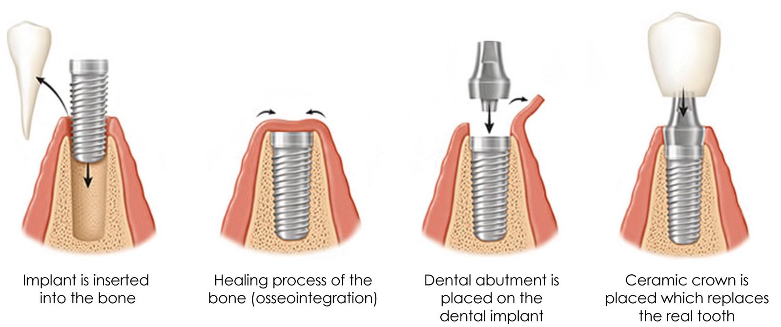 Dental Implant Process