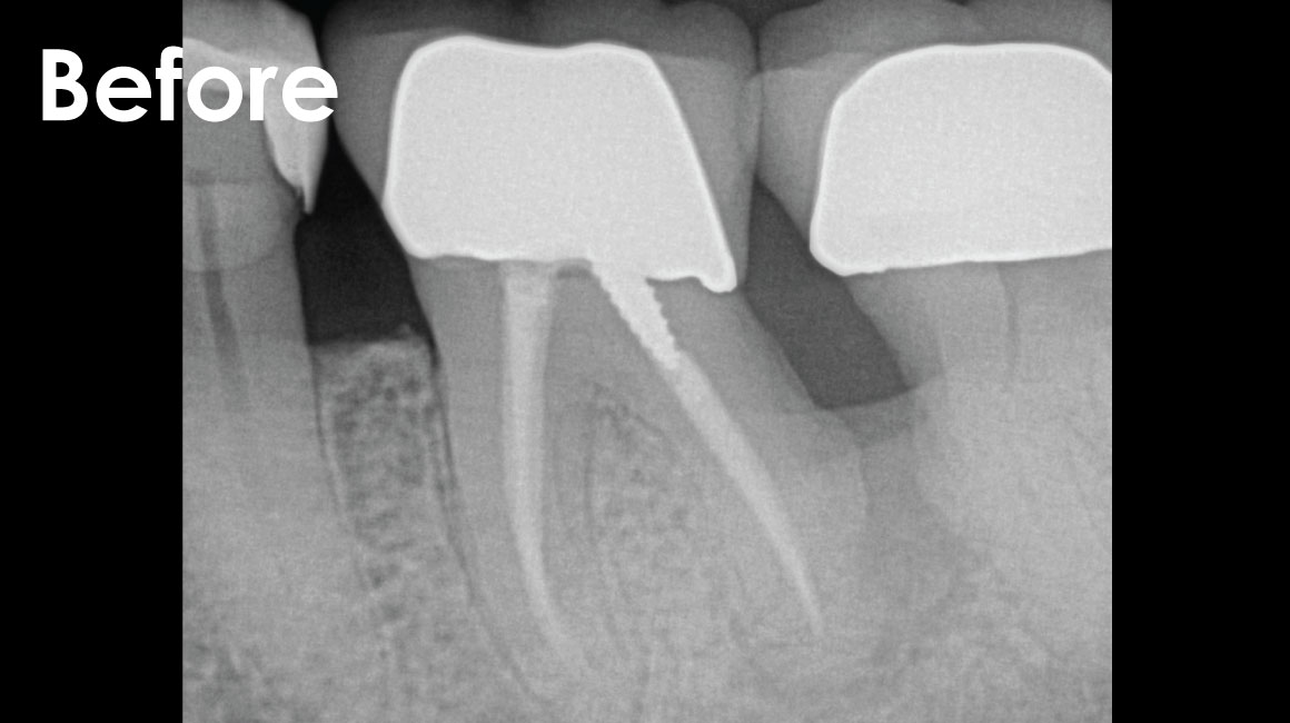 Lynnwood Dental Implants
