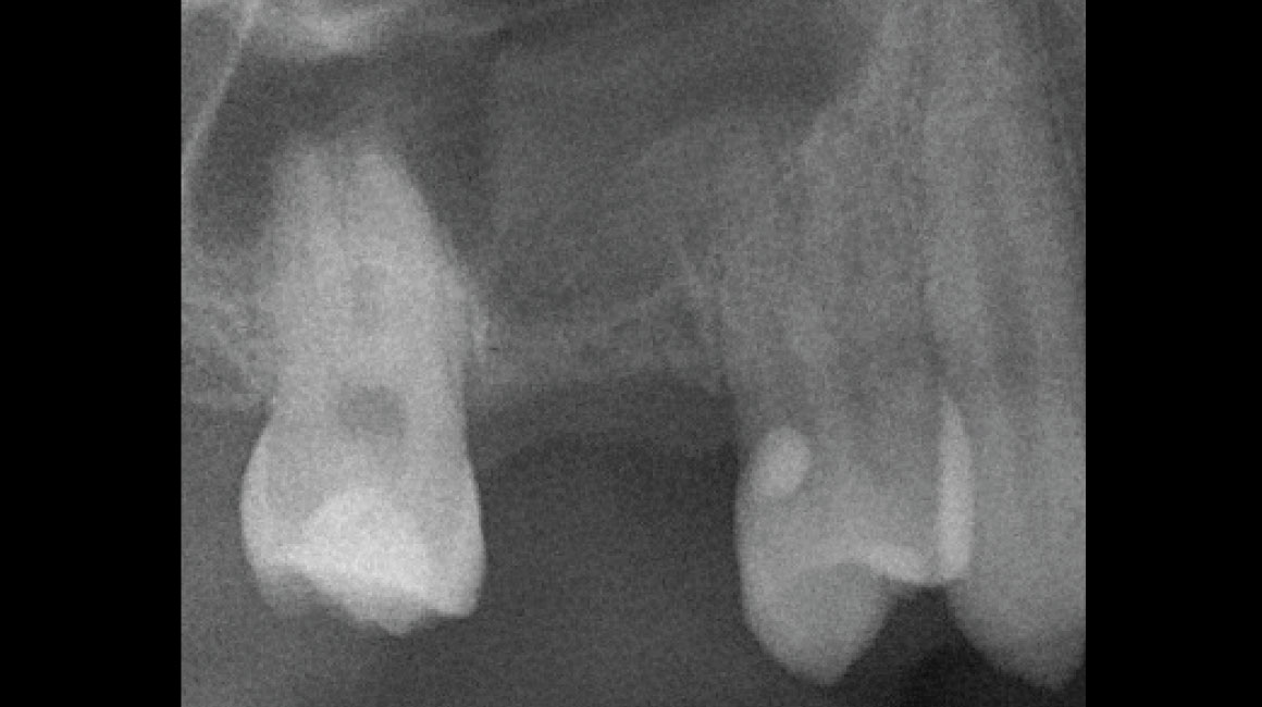 Lynnwood Dental Implants