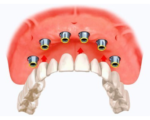 Implant Supported Fixed Prosthesis in Lynnwood