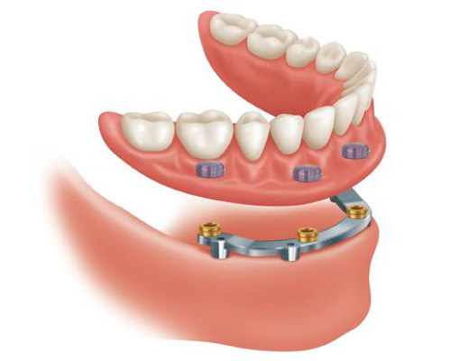 Implant Supported Removable Dentures in Lynnwood
