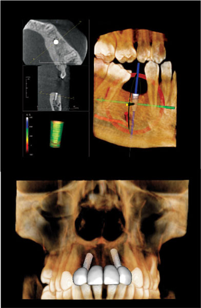 Cone Beam 3D Imaging for Dental Implants